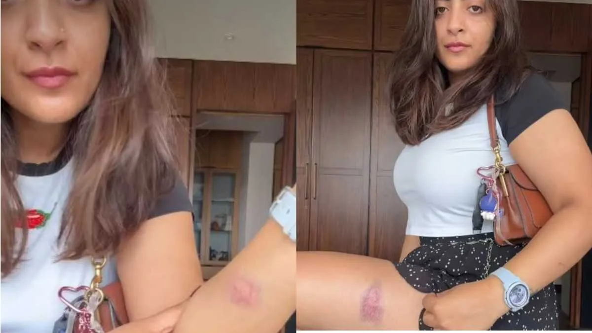 ‘Don’t Scare Us So Much That…’ Aamir Khan’s Niece Zayn Marie Reveals Injury Marks After Detention Amid CJP Protest